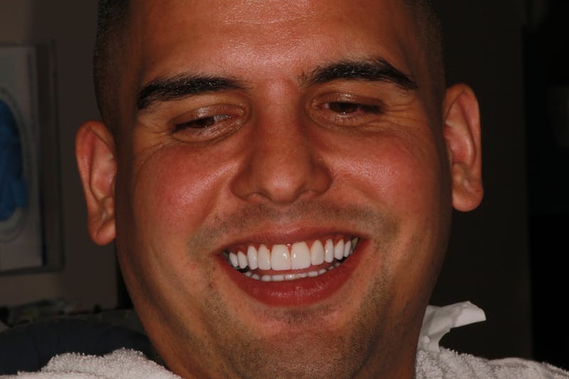 Ultra Thin Veneers Before & After Gallery - Patient 124056 - Image 2