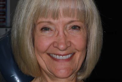 Ultra Thin Veneers Before & After Gallery - Patient 222271 - Image 1