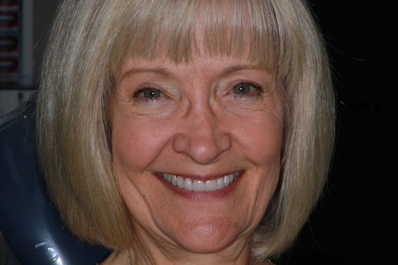 Ultra Thin Veneers Before & After Gallery - Patient 222271 - Image 1