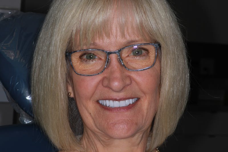 Ultra Thin Veneers Before & After Gallery - Patient 222271 - Image 2