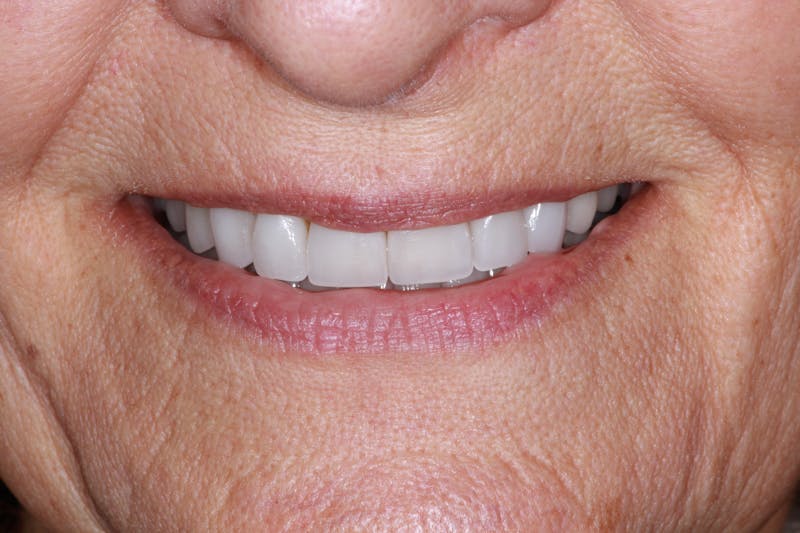 Ultra Thin Veneers Before & After Gallery - Patient 222271 - Image 3