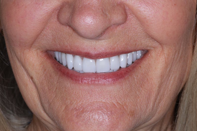 Ultra Thin Veneers Before & After Gallery - Patient 222271 - Image 4