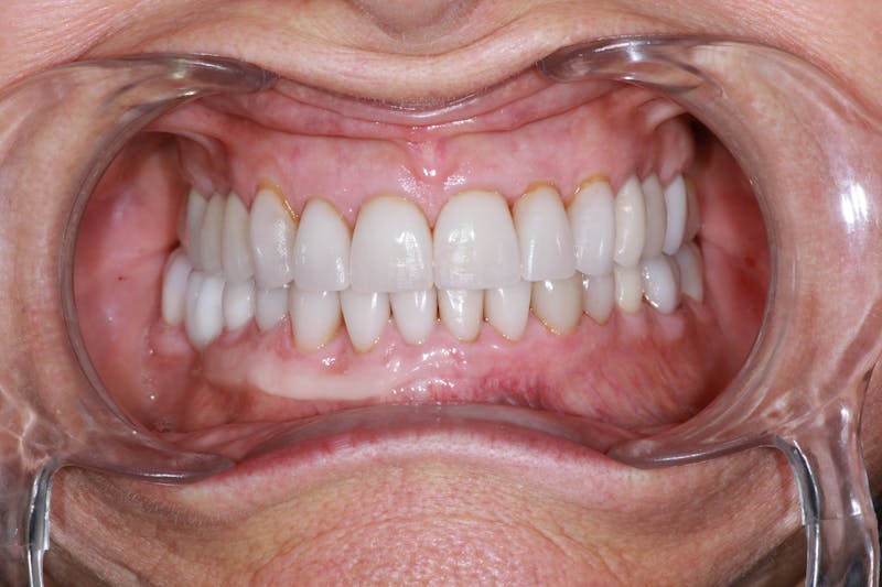 Ultra Thin Veneers Before & After Gallery - Patient 222271 - Image 5