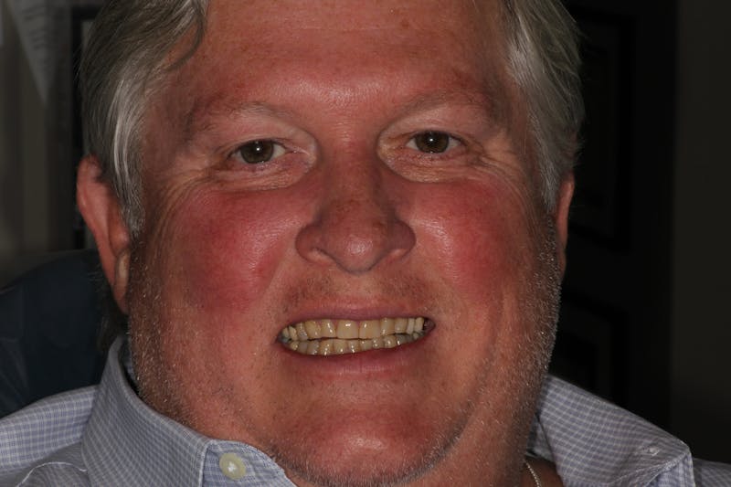 Ultra Thin Veneers Before & After Gallery - Patient 274674 - Image 1