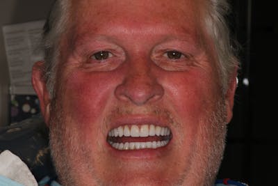 Ultra Thin Veneers Before & After Gallery - Patient 274674 - Image 2