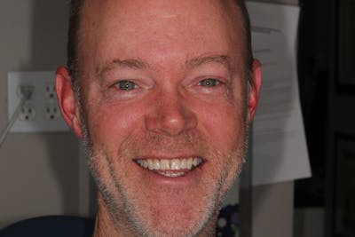 Ultra Thin Veneers Before & After Gallery - Patient 158621 - Image 1