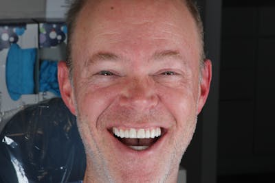 Ultra Thin Veneers Before & After Gallery - Patient 158621 - Image 2