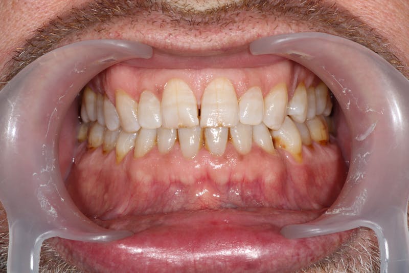 Ultra Thin Veneers Before & After Gallery - Patient 158621 - Image 3
