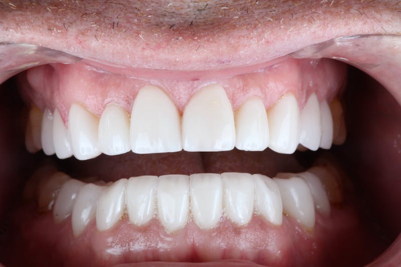 Ultra Thin Veneers Before & After Gallery - Patient 158621 - Image 4