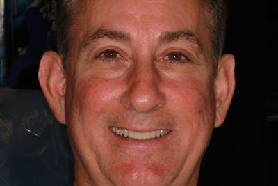 Ultra Thin Veneers Before & After Gallery - Patient 329523 - Image 1