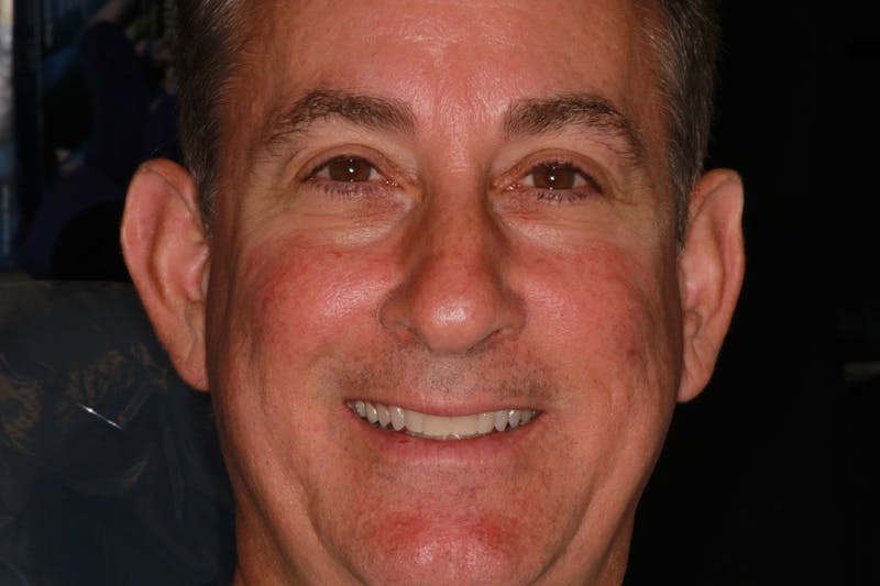 Ultra Thin Veneers Before & After Gallery - Patient 329523 - Image 1