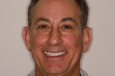 Ultra Thin Veneers Before & After Gallery - Patient 329523 - Image 2