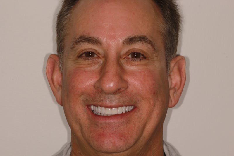 Ultra Thin Veneers Before & After Gallery - Patient 329523 - Image 2