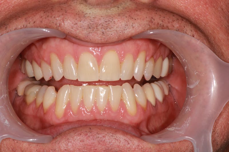 Ultra Thin Veneers Before & After Gallery - Patient 329523 - Image 3