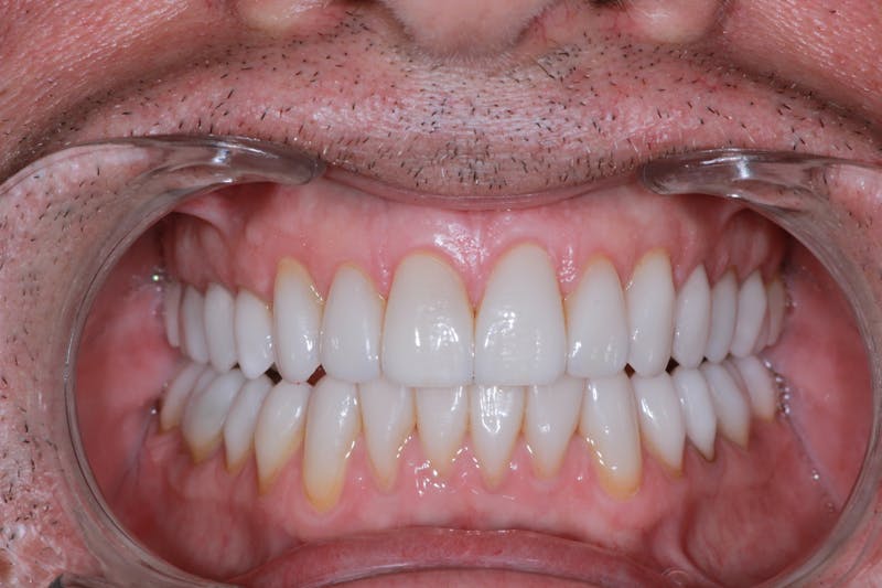 Ultra Thin Veneers Before & After Gallery - Patient 329523 - Image 4