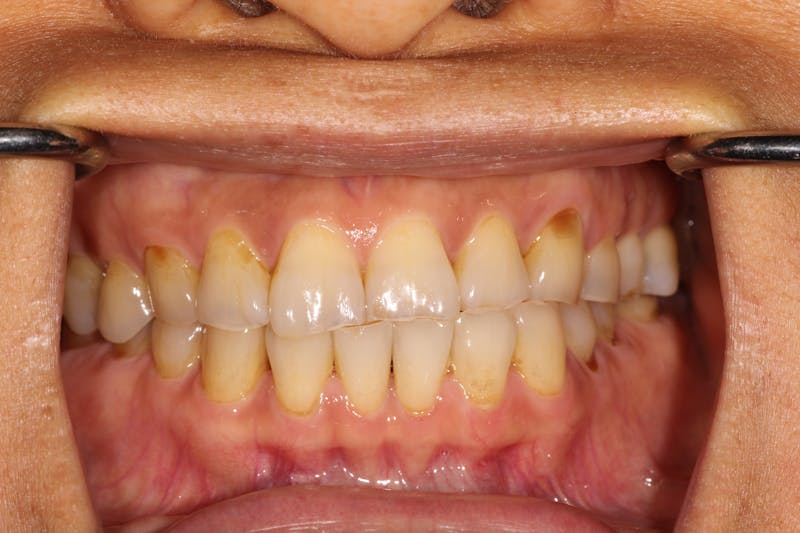 Ultra Thin Veneers Before & After Gallery - Patient 352824 - Image 1