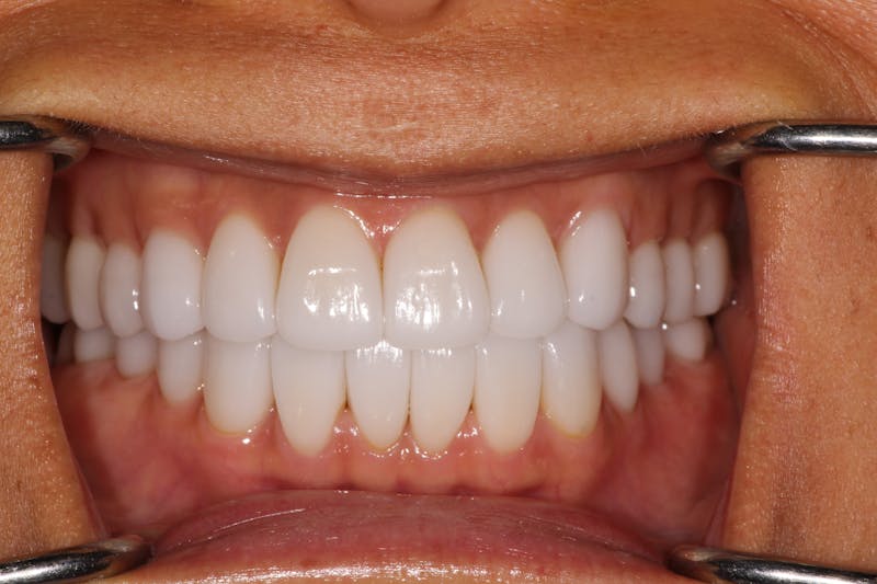 Ultra Thin Veneers Before & After Gallery - Patient 352824 - Image 2