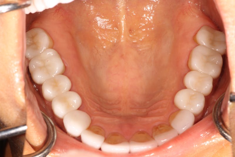 Ultra Thin Veneers Before & After Gallery - Patient 352824 - Image 4