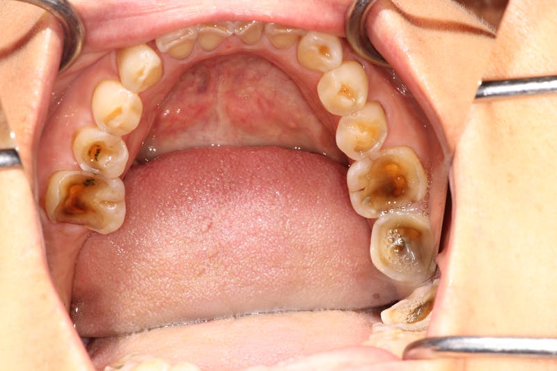 Ultra Thin Veneers Before & After Gallery - Patient 352824 - Image 5