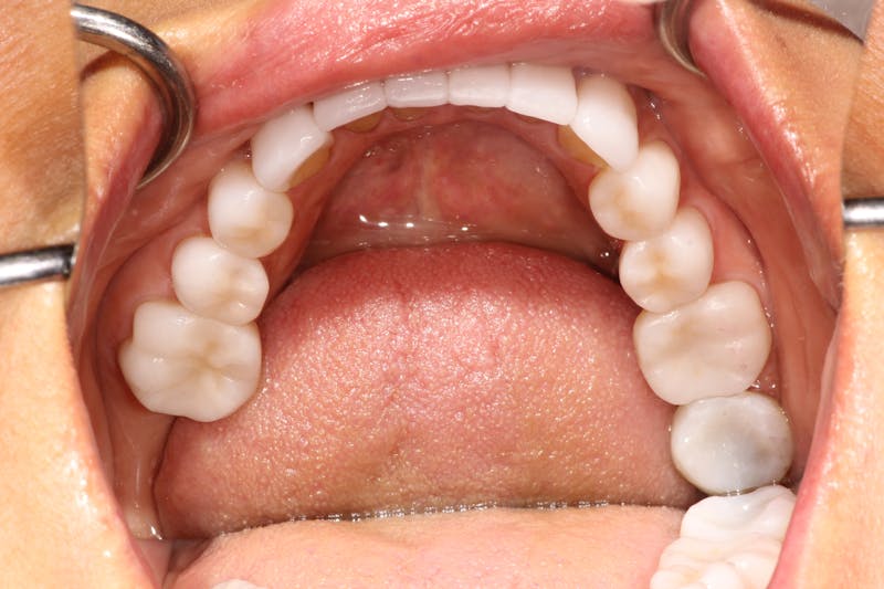 Ultra Thin Veneers Before & After Gallery - Patient 352824 - Image 6