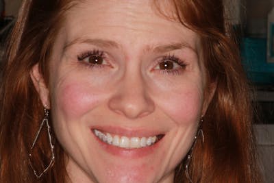 Ultra Thin Veneers Before & After Gallery - Patient 695992 - Image 1