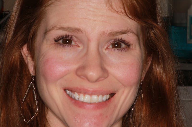 Ultra Thin Veneers Before & After Gallery - Patient 695992 - Image 1