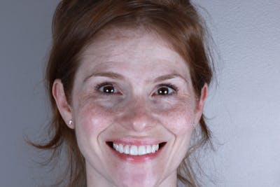 Ultra Thin Veneers Before & After Gallery - Patient 695992 - Image 2