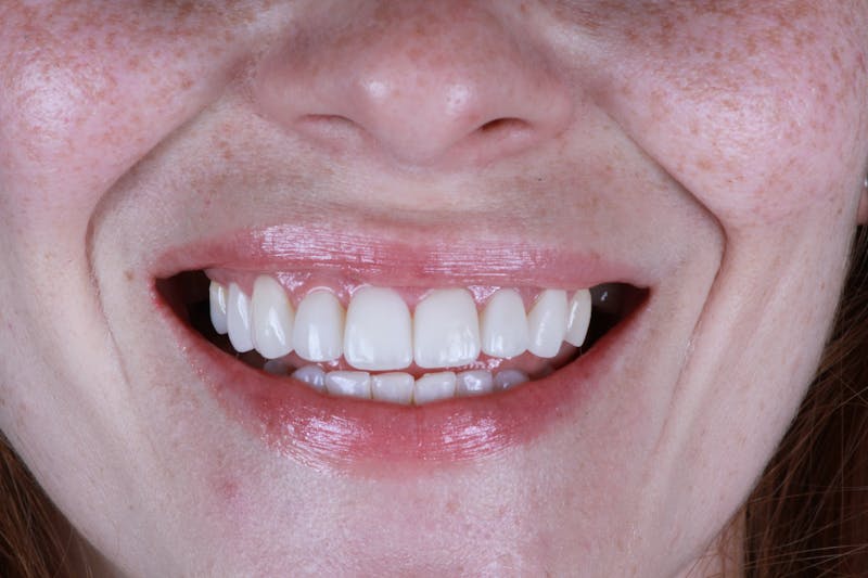 Ultra Thin Veneers Before & After Gallery - Patient 695992 - Image 4