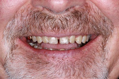 Ultra Thin Veneers Before & After Gallery - Patient 308935 - Image 1