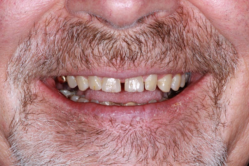Ultra Thin Veneers Before & After Gallery - Patient 308935 - Image 1
