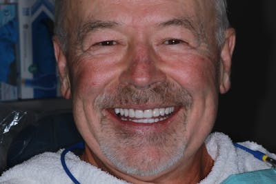 Ultra Thin Veneers Before & After Gallery - Patient 308935 - Image 2