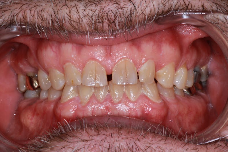 Ultra Thin Veneers Before & After Gallery - Patient 308935 - Image 3