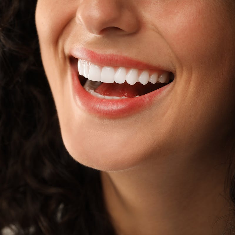 veneers