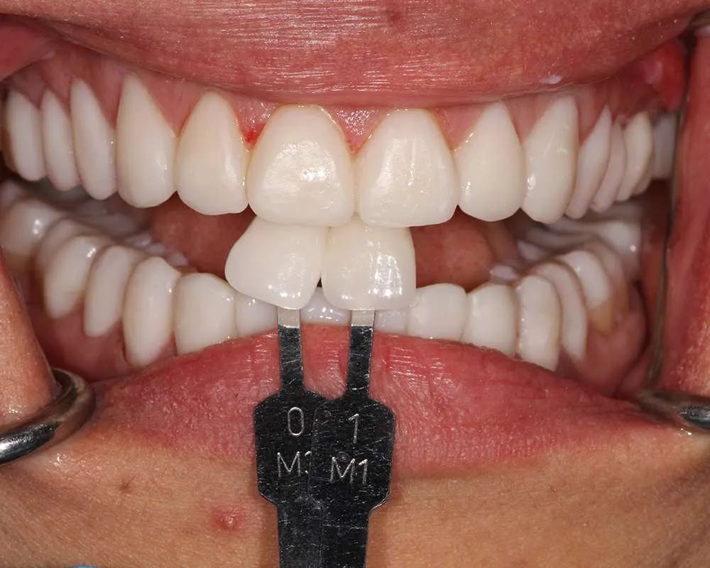 Close up of patient one's teeth