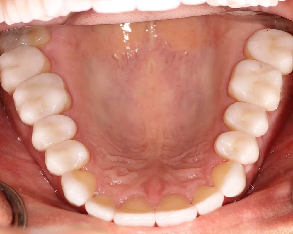 Close up of patient one's bottom teeth