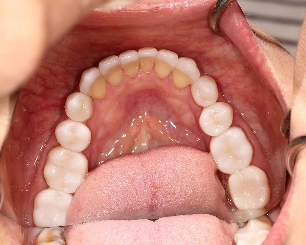 Close up of patient one's teeth