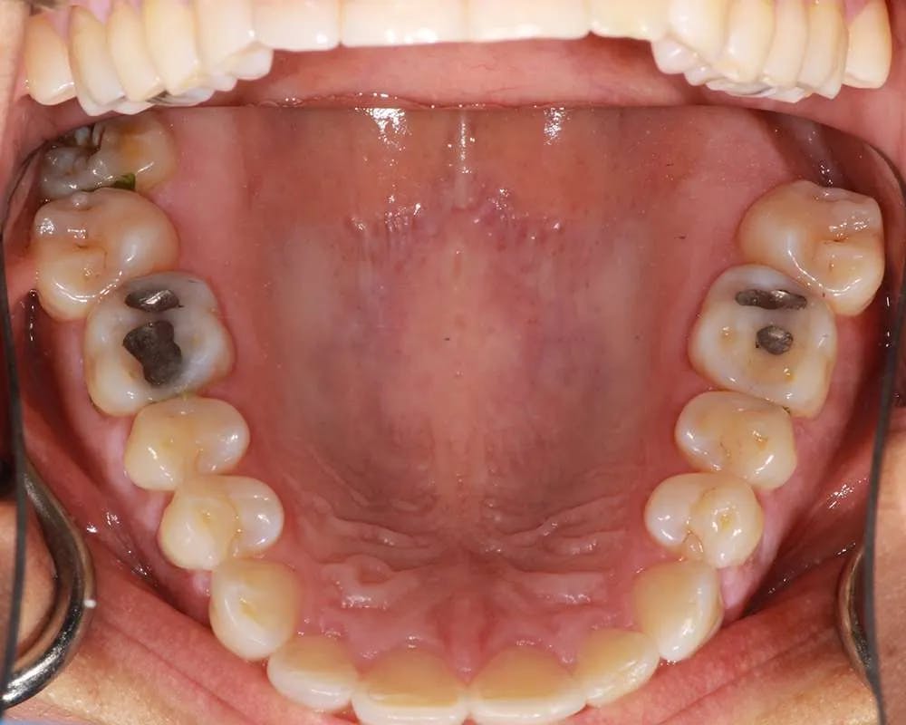 Patient one upper teeth