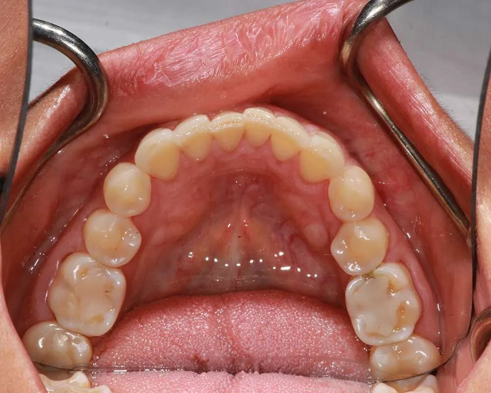 Patient one lower teeth