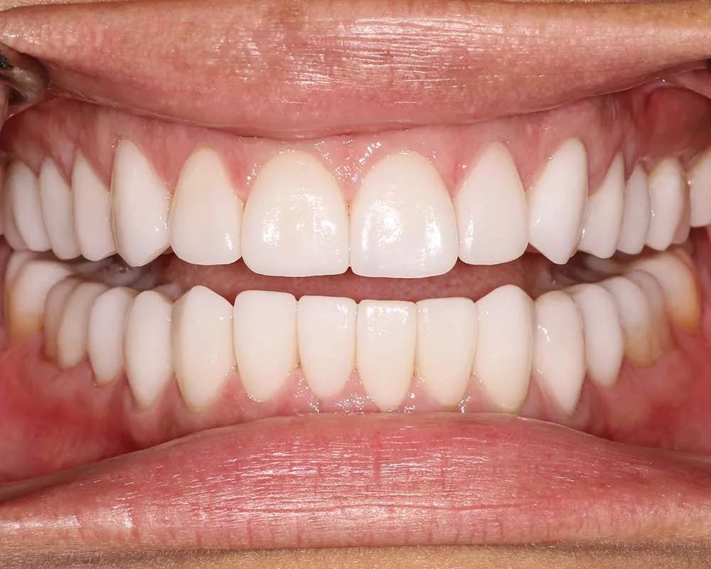 After image of patient one's teeth