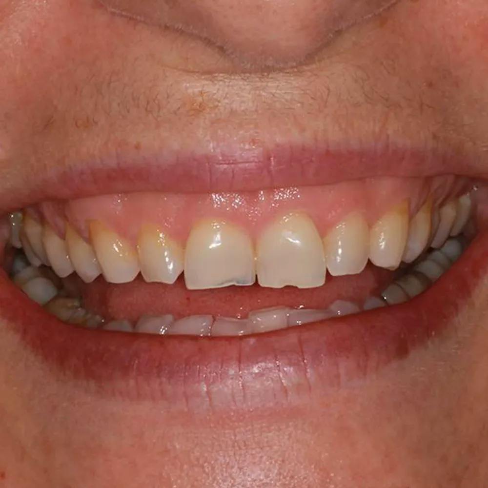 Patient three before