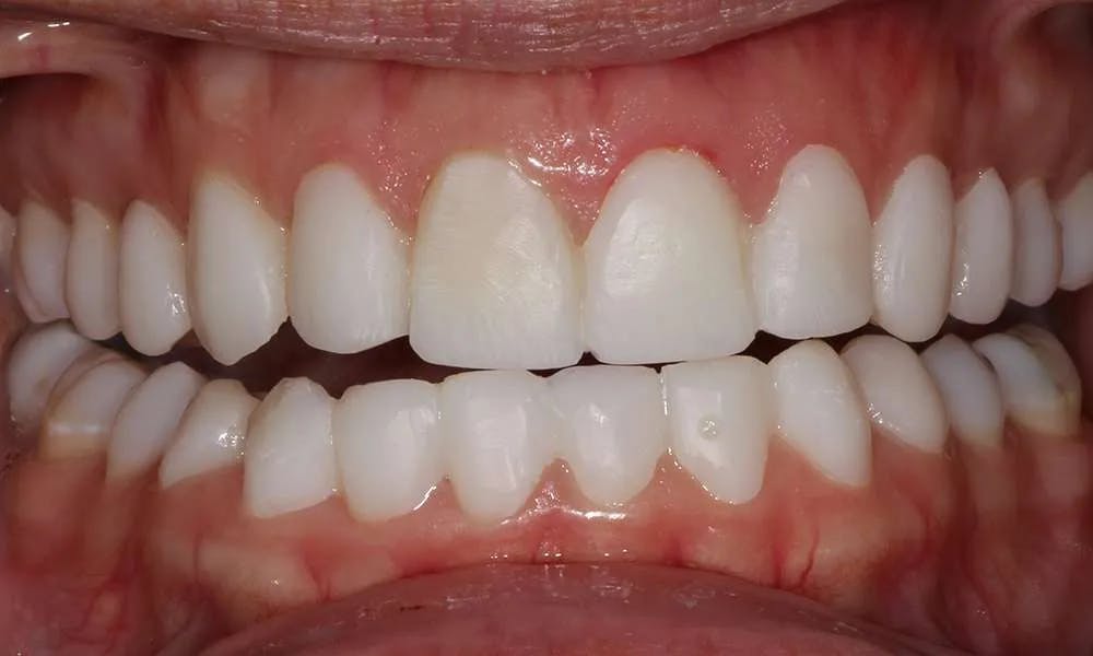 Patient five before and after image 3