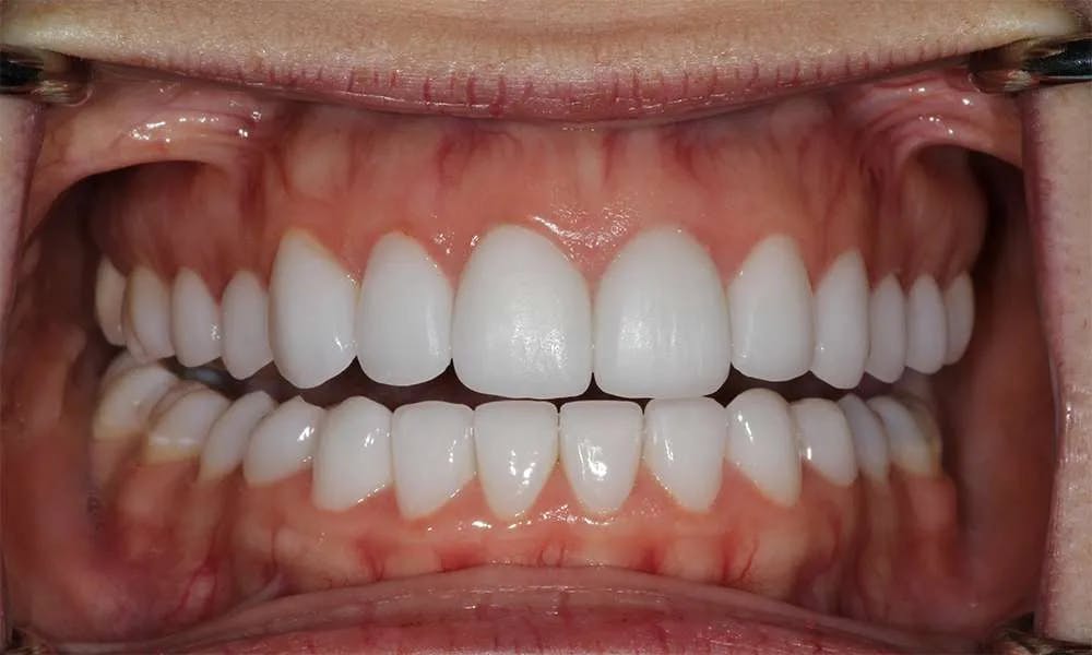 Patient five before and after image 5