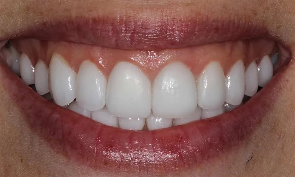 Patient five before and after image 6