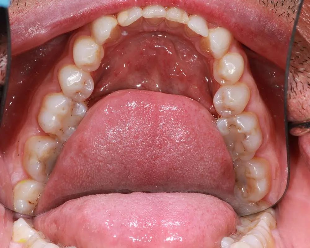 Patient six before and after image 2