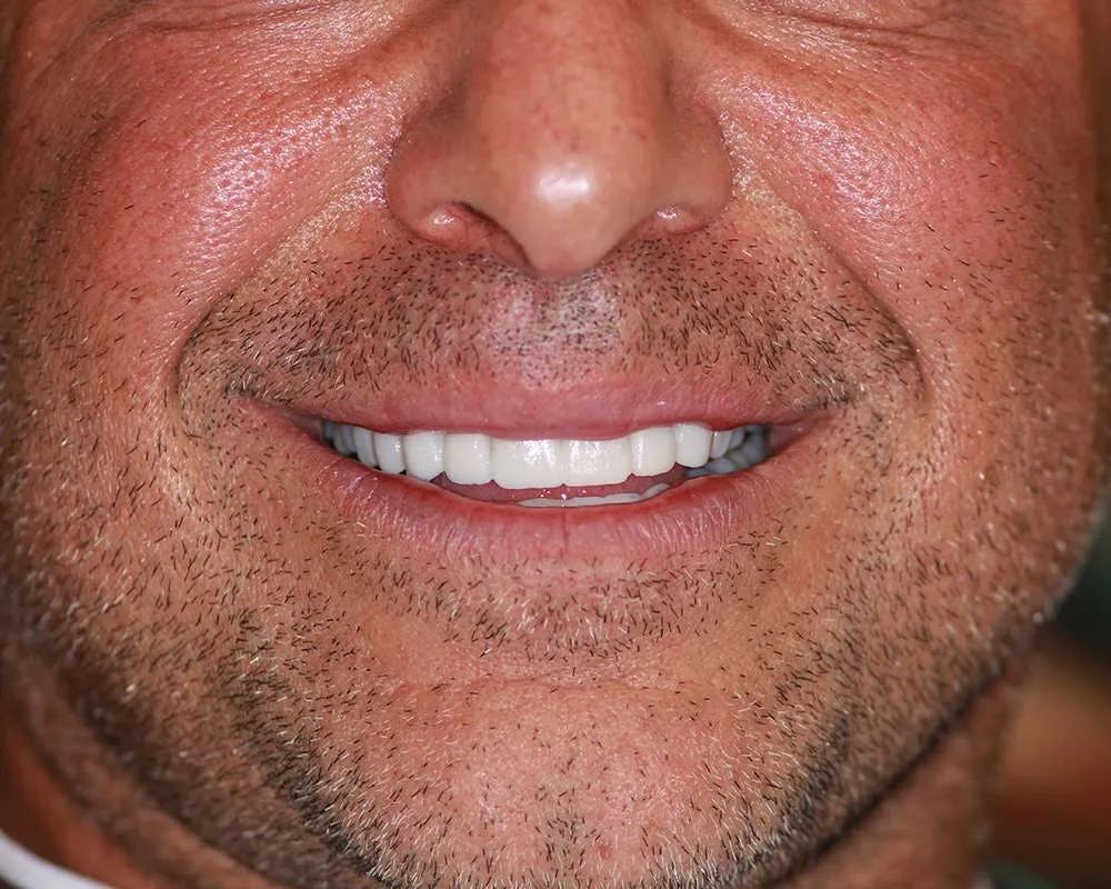 Patient six before and after image 4