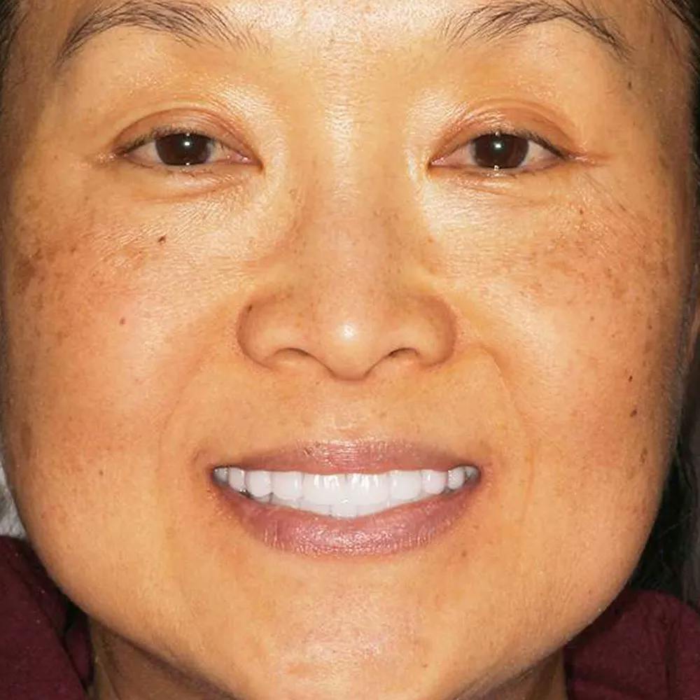 Patient nine after image