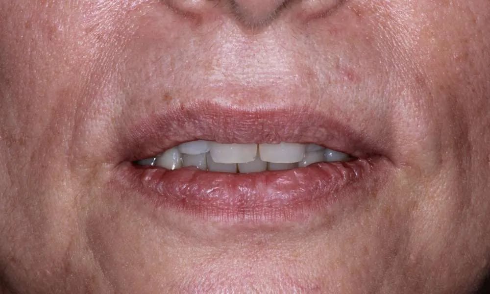 Patient eleven before and after image 1