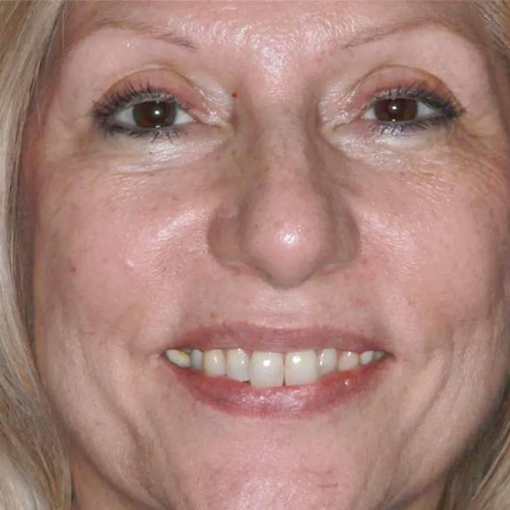 Patient eleven before