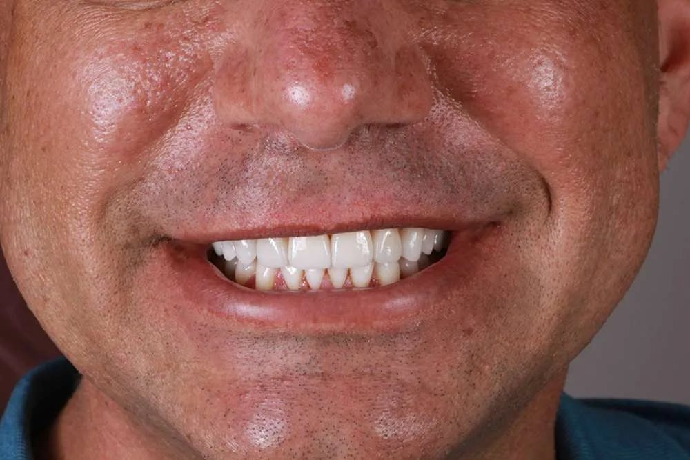 Patient twelve before and after image 5