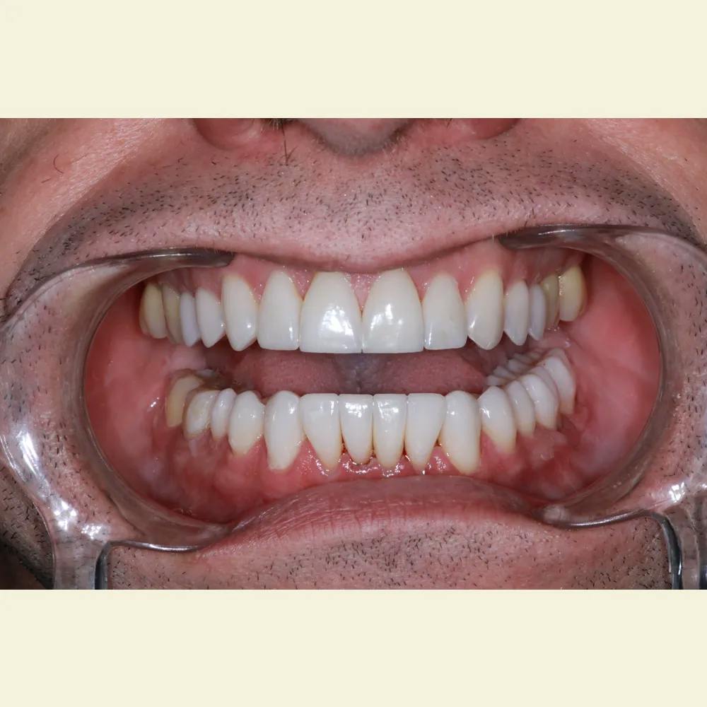 Patient thirteen after